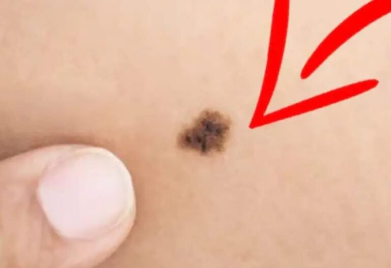 अगर यहां है तिल तो अनलिमिटेड किस्मत, सात पुश्तों तक नहीं होगी पैसों की कमी! क्या है आपके पास